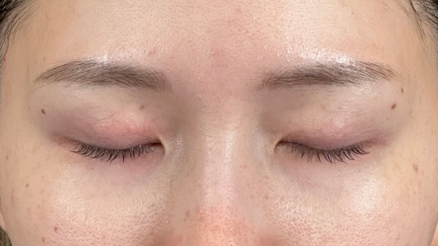 Postoperative Condition Part 1