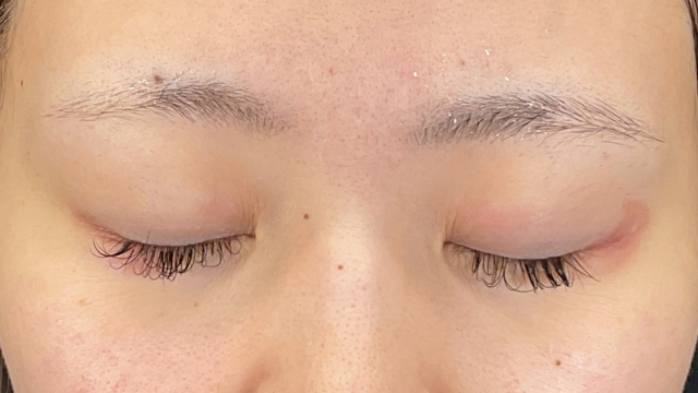 Postoperative Condition Part 1