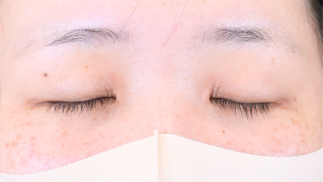 Postoperative Condition Part 1