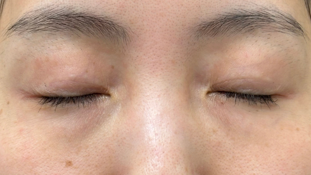 Postoperative Condition Part 1