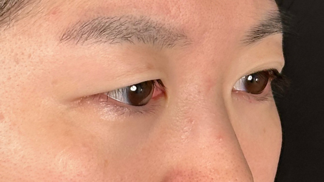 Postoperative Condition Part 1