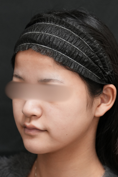 手術前の状態 その1