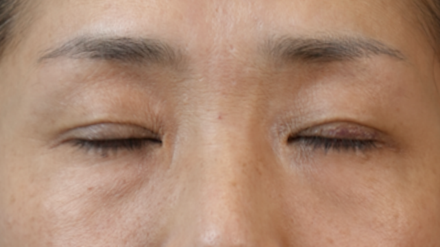 Postoperative Condition Part 1