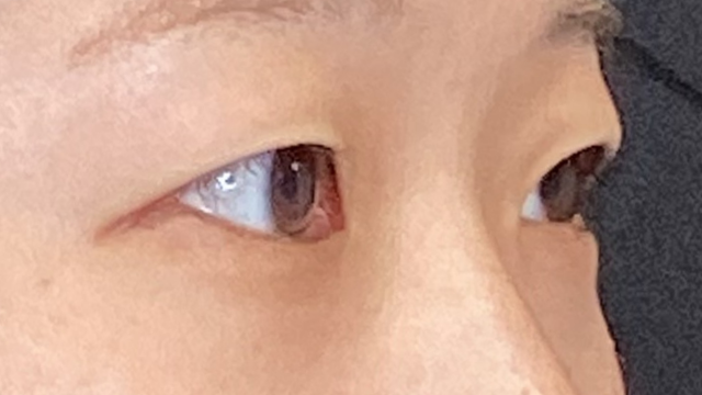 手术前的状态 其一