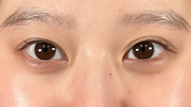 手術前の状態 その1