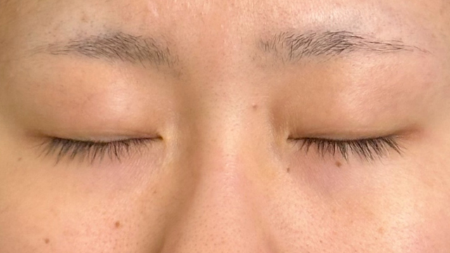 Postoperative Condition Part 1