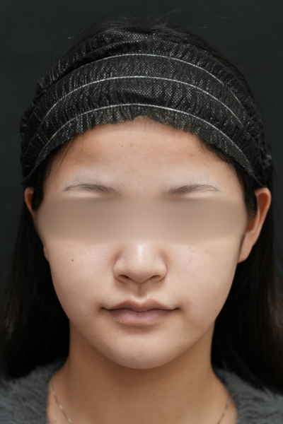 手術前の状態 その1