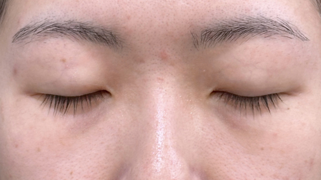 Postoperative Condition Part 1