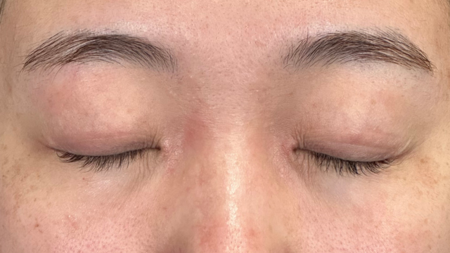 手術前の状態 その1