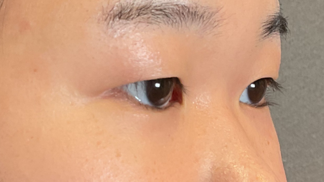 Postoperative Condition Part 1