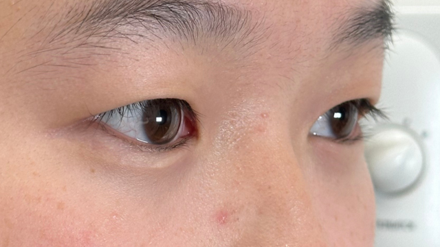 Postoperative Condition Part 1