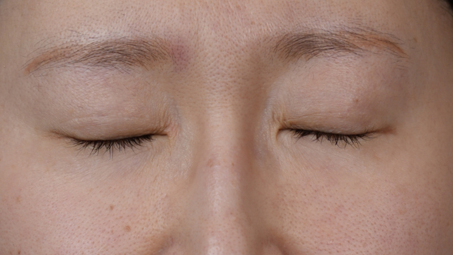 Postoperative Condition Part 1