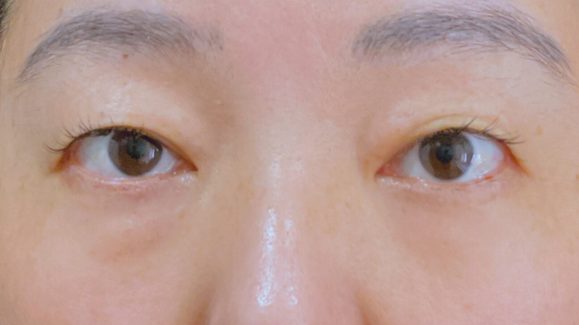 Postoperative Condition Part 1