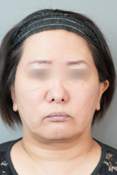 手術前の状態 その1