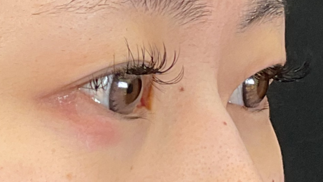 Postoperative Condition Part 1