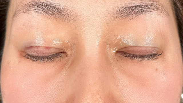 Postoperative Condition Part 1