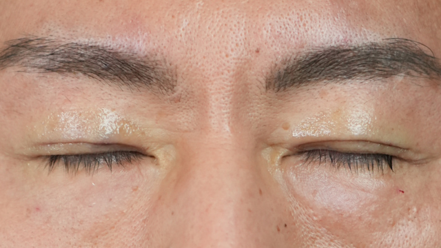 Postoperative Condition Part 1