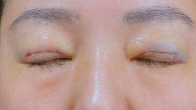 Postoperative Condition Part 1