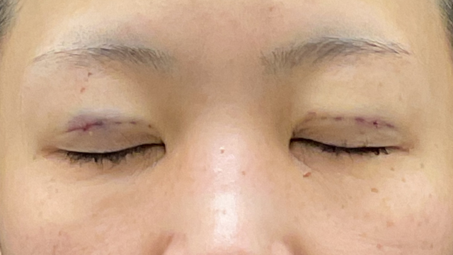 Postoperative Condition Part 1