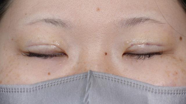 Postoperative Condition Part 1