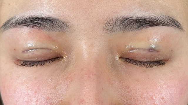 Postoperative Condition Part 1