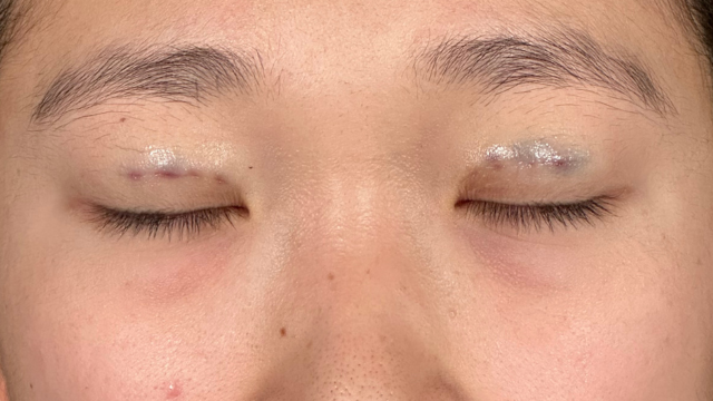 Postoperative Condition Part 1