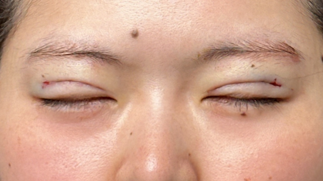 Postoperative Condition Part 1