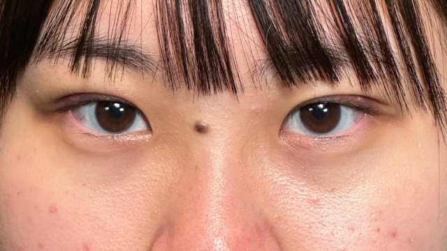 手术前的状态 其一