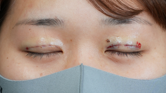 Postoperative Condition Part 1