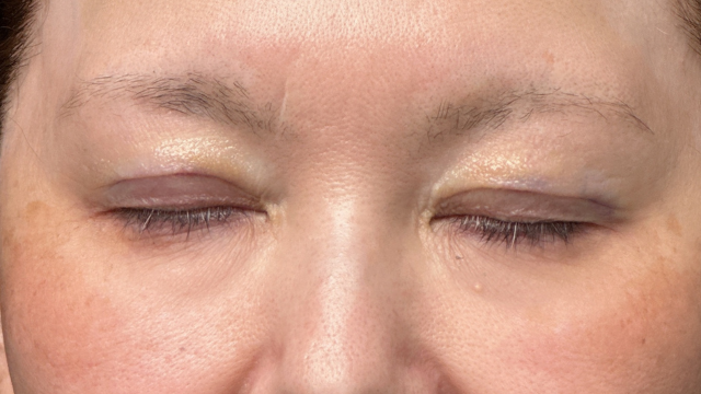 Postoperative Condition Part 1