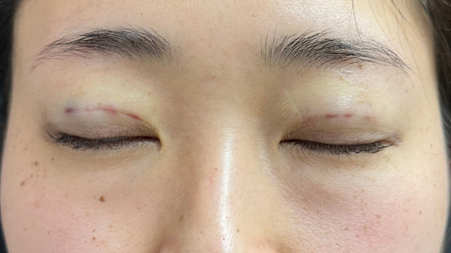 Postoperative Condition Part 1