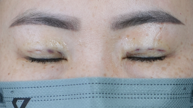 Postoperative Condition Part 1