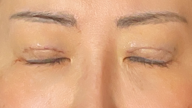 Postoperative Condition Part 1