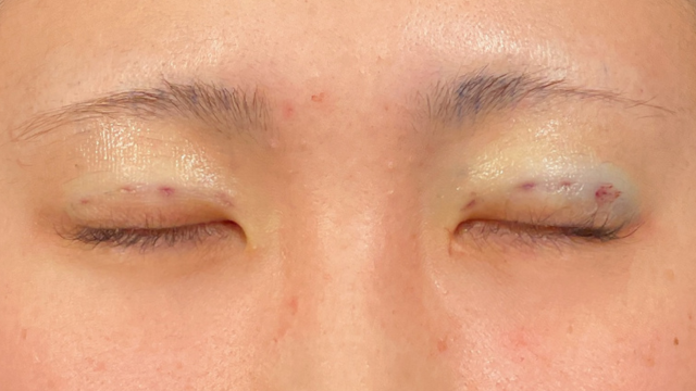 Postoperative Condition Part 1