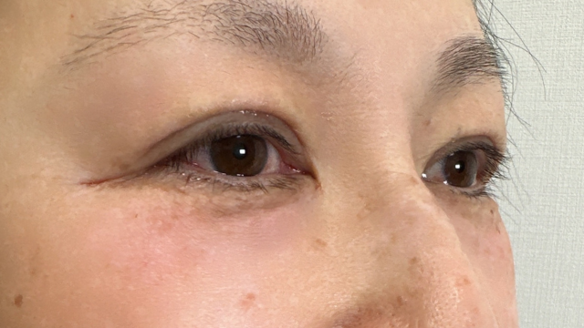 Postoperative Condition Part 1