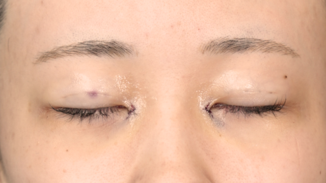 Postoperative Condition Part 1