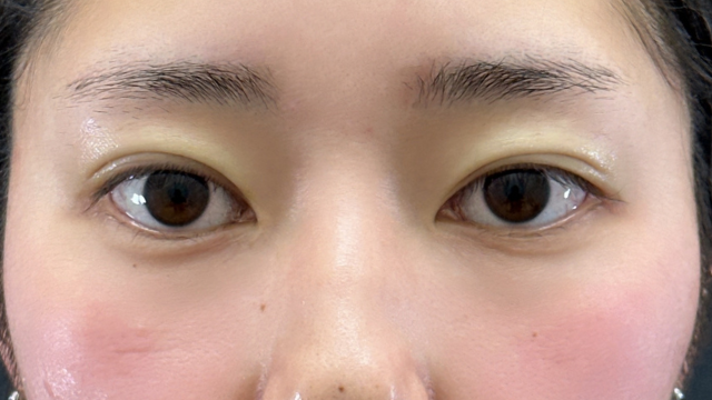 Postoperative Condition Part 1