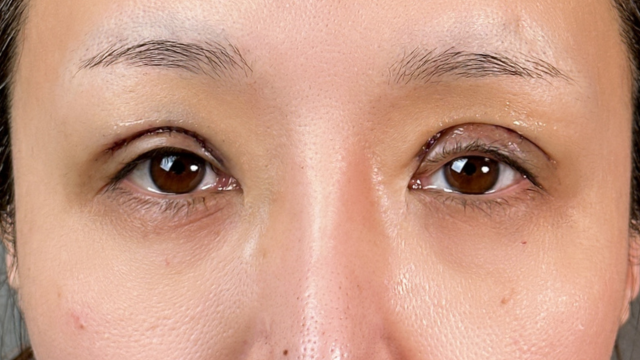 Postoperative Condition Part 1