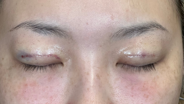 Postoperative Condition Part 1