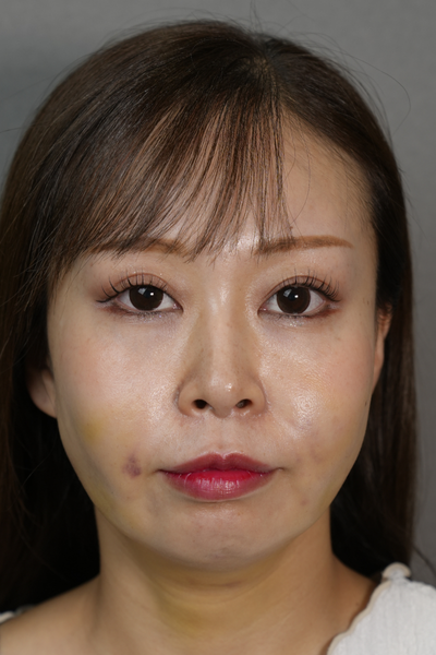 手術前の状態 その1