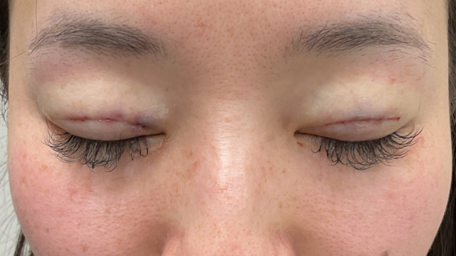 Postoperative Condition Part 1