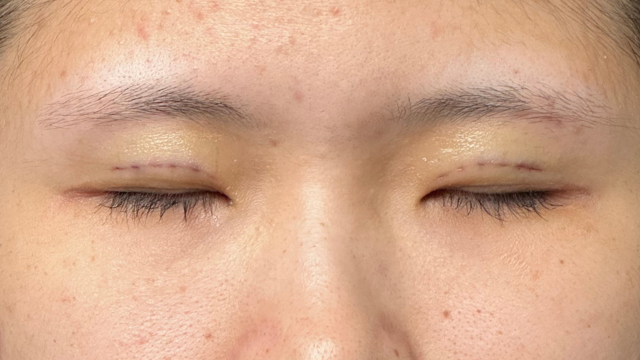 Postoperative Condition Part 1