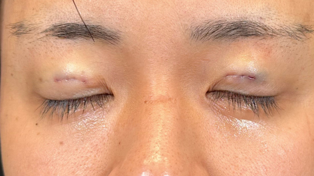 Postoperative Condition Part 1