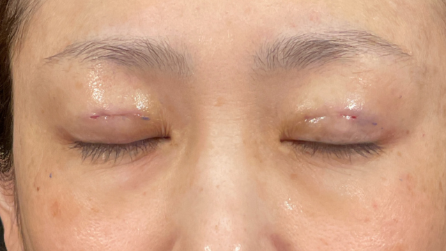 Postoperative Condition Part 1