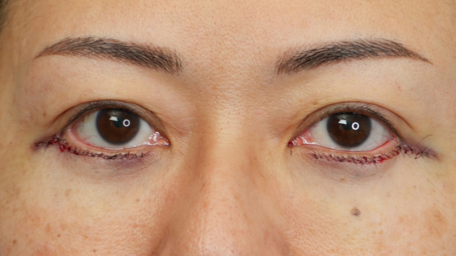 Postoperative Condition Part 1