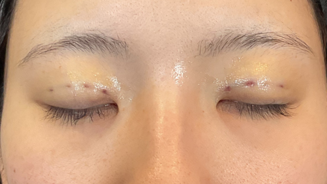 Postoperative Condition Part 1