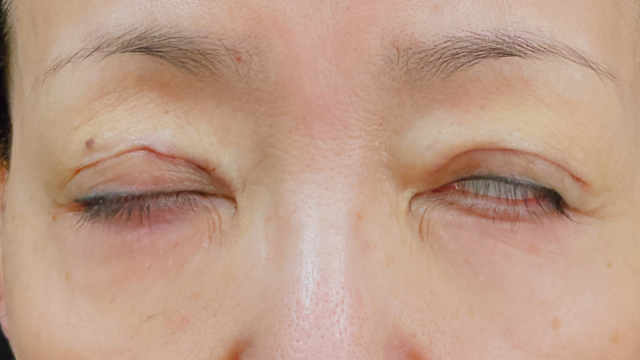 Postoperative Condition Part 1