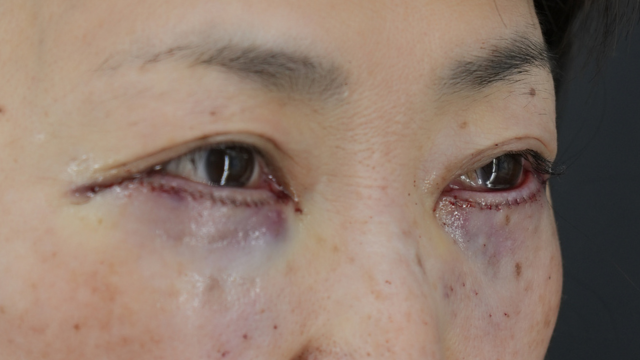 Postoperative Condition Part 1