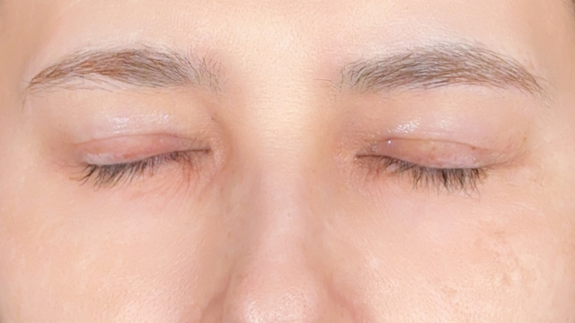 Postoperative Condition Part 1