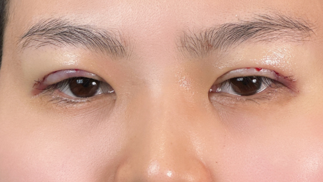 Postoperative Condition Part 1